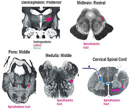 Spinothalamic Tract
